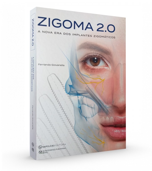  Zigoma 2.0 - A Nova Era Dos Implantes Zigomáticos