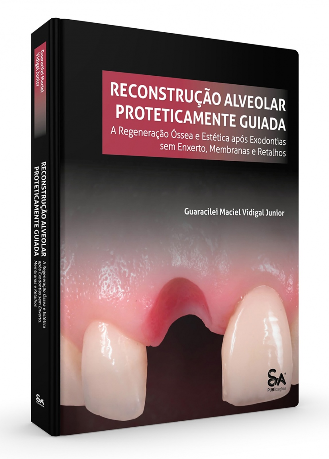 Reconstrução Alveolar Proteticamente Guiada: A Regeneração Óssea E Estética Após Exodontias Sem Enxerto, Membranas E Retalhos